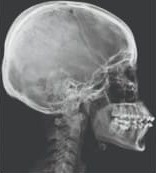 Radiografía lateral de cráneo